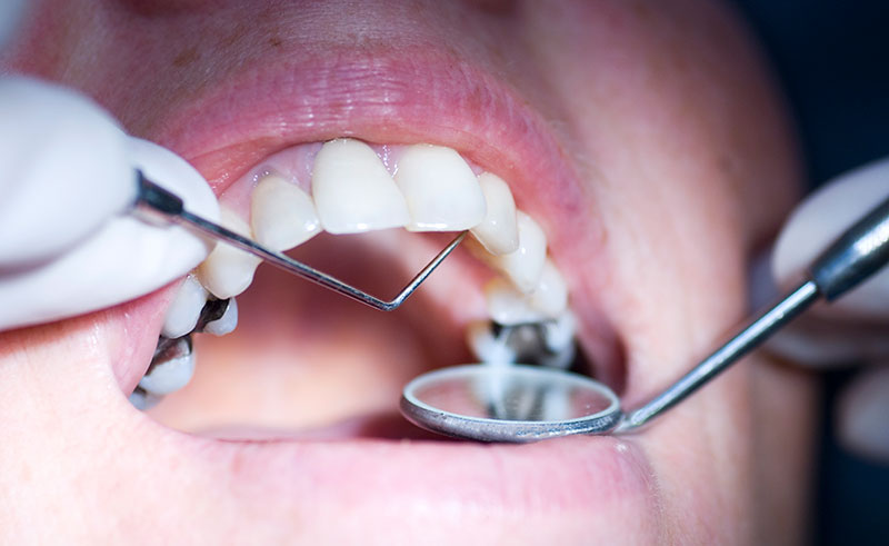 Dentist tools in a patients mouth